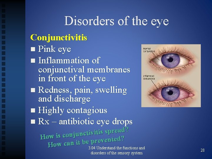 Disorders of the eye Conjunctivitis n Pink eye n Inflammation of conjunctival membranes in