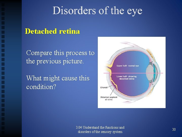 Detached retina Compare this process to the previous picture. What might cause this condition?
