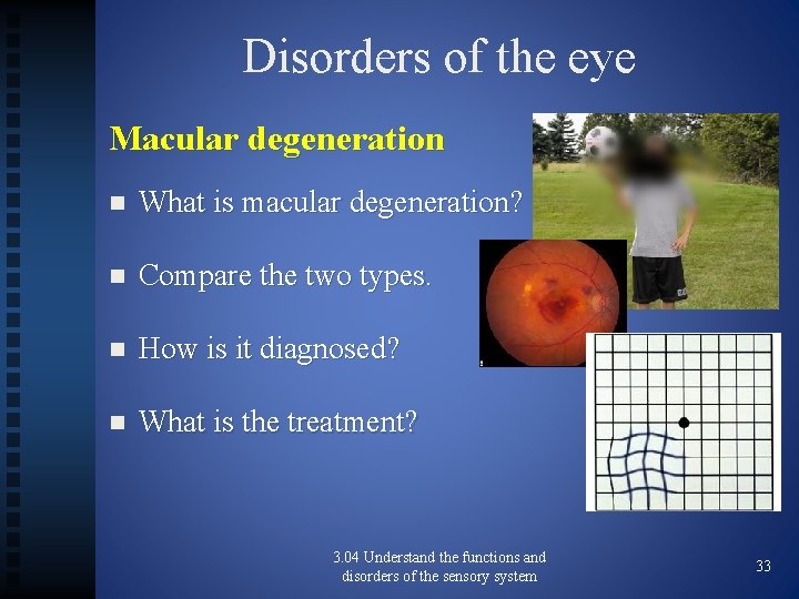 Disorders of the eye Macular degeneration n What is macular degeneration? n Compare the