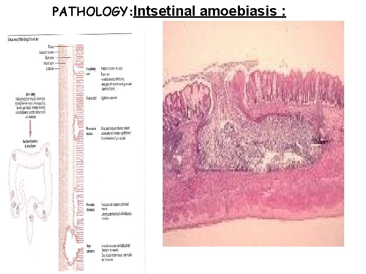 PATHOLOGY: Intsetinal amoebiasis : 