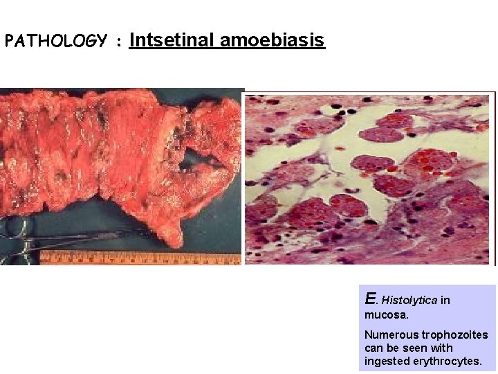 PATHOLOGY : Intsetinal amoebiasis E. Histolytica in mucosa. Numerous trophozoites can be seen with