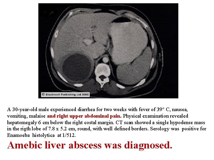 A 30 -year-old male experienced diarrhea for two weeks with fever of 39° C,