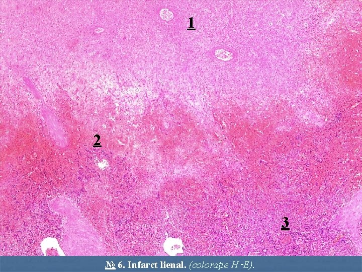 1 2 3 № 6. Infarct lienal. (coloraţie H‑E). 