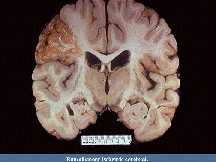 Ramolisment ischemic cerebral. 