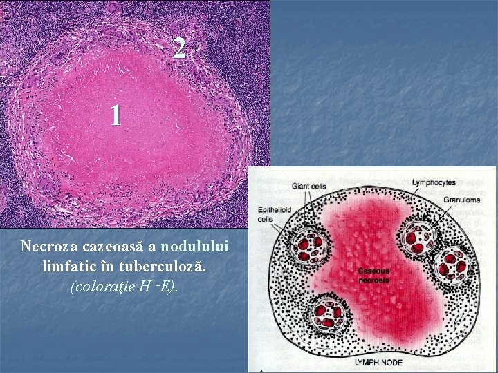 2 1 Necroza cazeoasă a nodulului limfatic în tuberculoză. (coloraţie H‑E). 