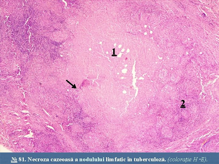 1 2 № 81. Necroza cazeoasă a nodulului limfatic în tuberculoză. (coloraţie H‑E). 