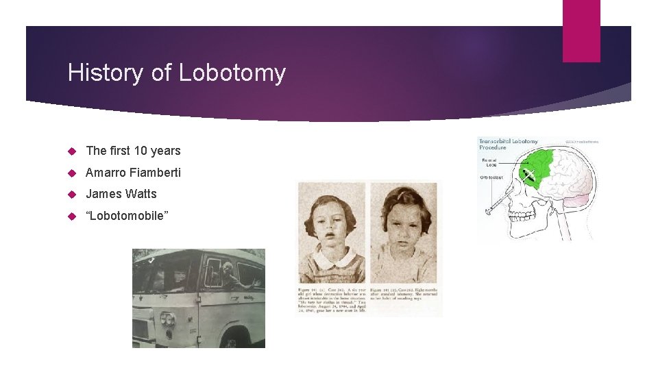 History of Lobotomy The first 10 years Amarro Fiamberti James Watts “Lobotomobile” 