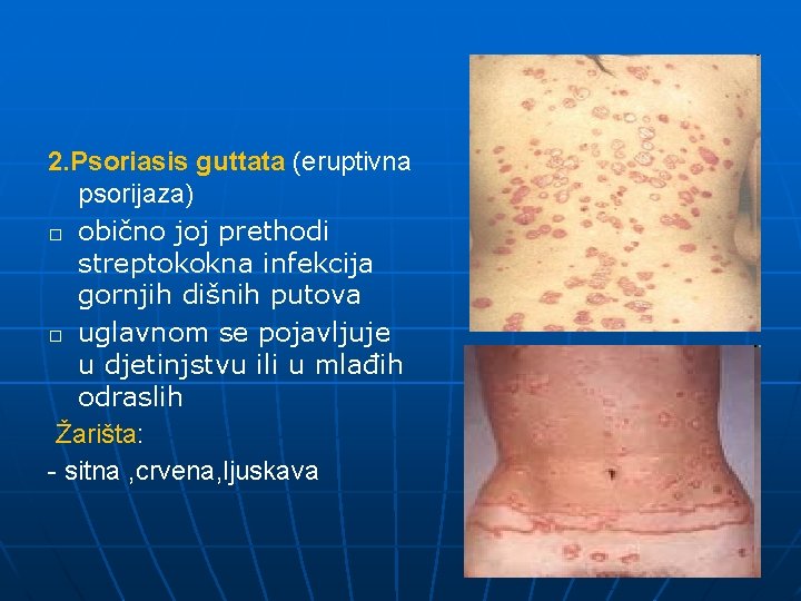 2. Psoriasis guttata (eruptivna psorijaza) � obično joj prethodi streptokokna infekcija gornjih dišnih putova