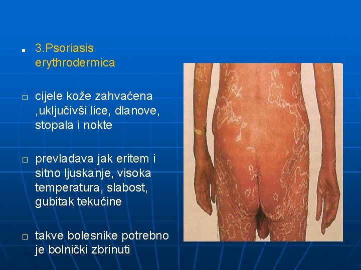■ � � � 3. Psoriasis erythrodermica cijele kože zahvaćena , uključivši lice, dlanove,