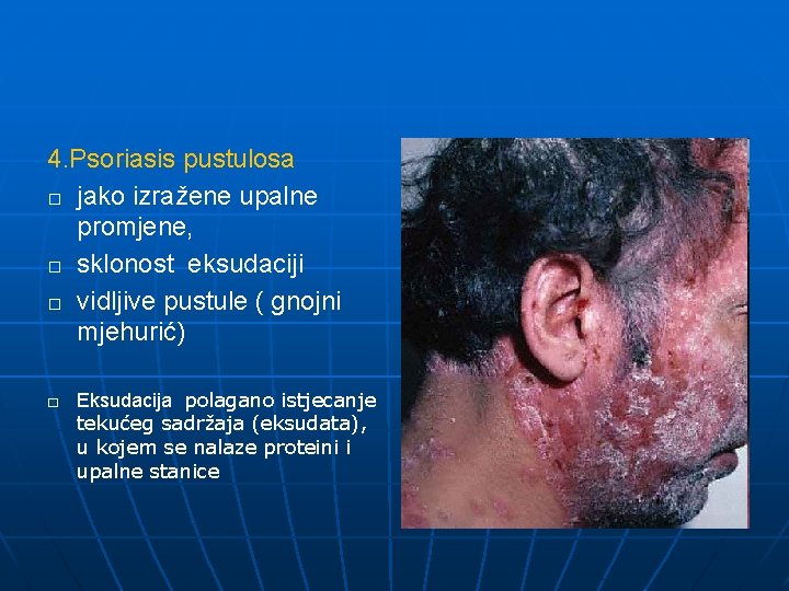 4. Psoriasis pustulosa � jako izražene upalne promjene, � sklonost eksudaciji � vidljive pustule