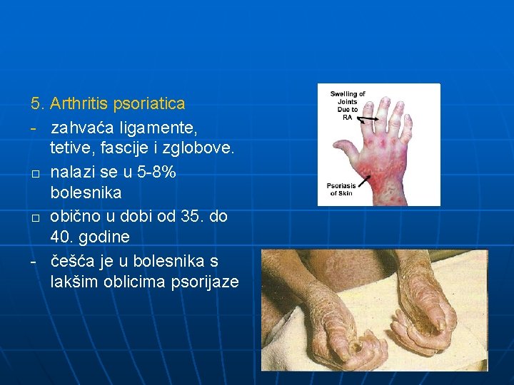 5. Arthritis psoriatica - zahvaća ligamente, tetive, fascije i zglobove. � nalazi se u