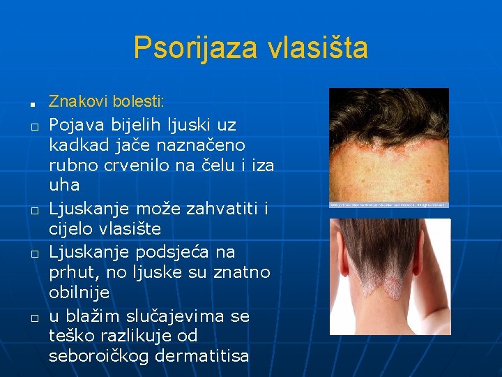 Psorijaza vlasišta ■ � � Znakovi bolesti: Pojava bijelih ljuski uz kadkad jače naznačeno