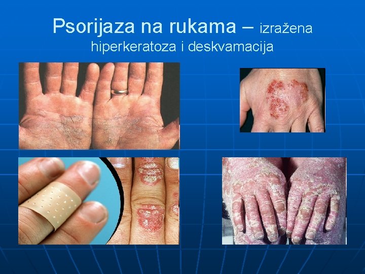 Psorijaza na rukama – izražena hiperkeratoza i deskvamacija 