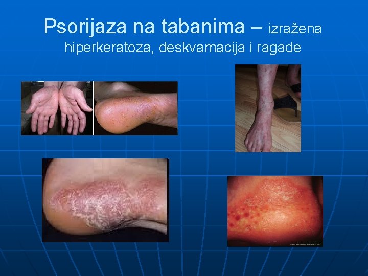 Psorijaza na tabanima – izražena hiperkeratoza, deskvamacija i ragade 