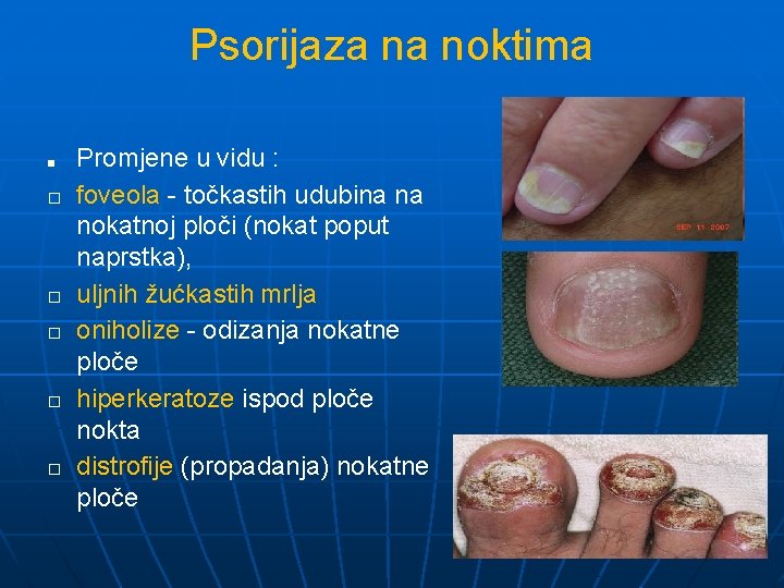 Psorijaza na noktima ■ � � � Promjene u vidu : foveola - točkastih