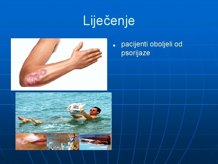 Liječenje ■ pacijenti oboljeli od psorijaze 