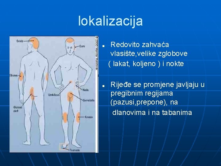 lokalizacija ■ ■ Redovito zahvaća vlasište, velike zglobove ( lakat, koljeno ) i nokte