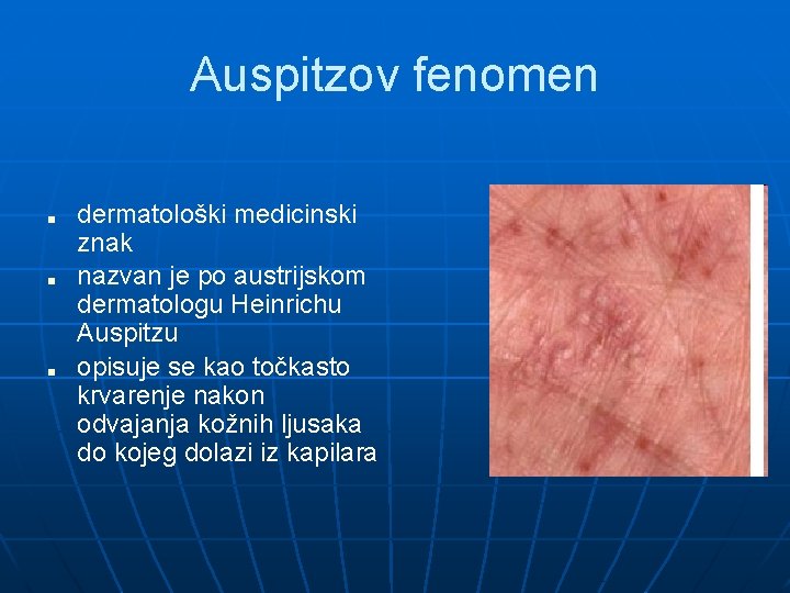 Auspitzov fenomen ■ ■ ■ dermatološki medicinski znak nazvan je po austrijskom dermatologu Heinrichu