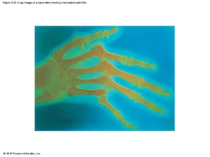 Figure 5. 33 X-ray image of a hand deformed by rheumatoid arthritis. © 2015