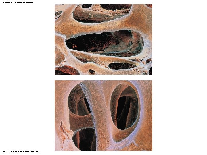 Figure 5. 36 Osteoporosis. © 2015 Pearson Education, Inc. 