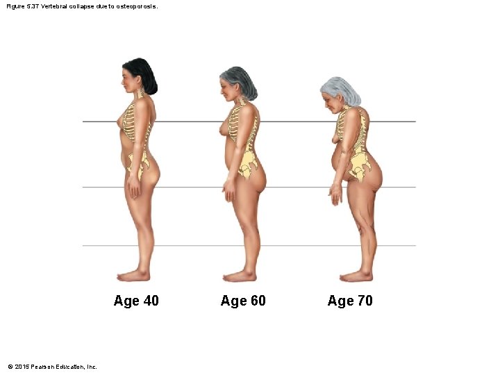Figure 5. 37 Vertebral collapse due to osteoporosis. Age 40 © 2015 Pearson Education,