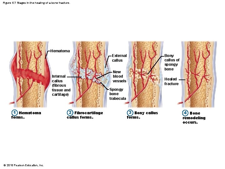 Figure 5. 7 Stages in the healing of a bone fracture. Hematoma Bony callus