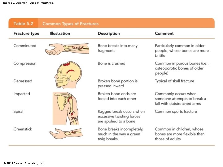 Table 5. 2 Common Types of Fractures. © 2015 Pearson Education, Inc. 