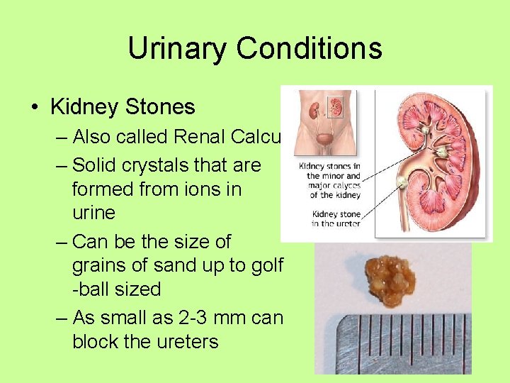Urinary Conditions • Kidney Stones – Also called Renal Calculi – Solid crystals that