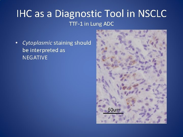 IHC as a Diagnostic Tool in NSCLC TTF-1 in Lung ADC • Cytoplasmic staining