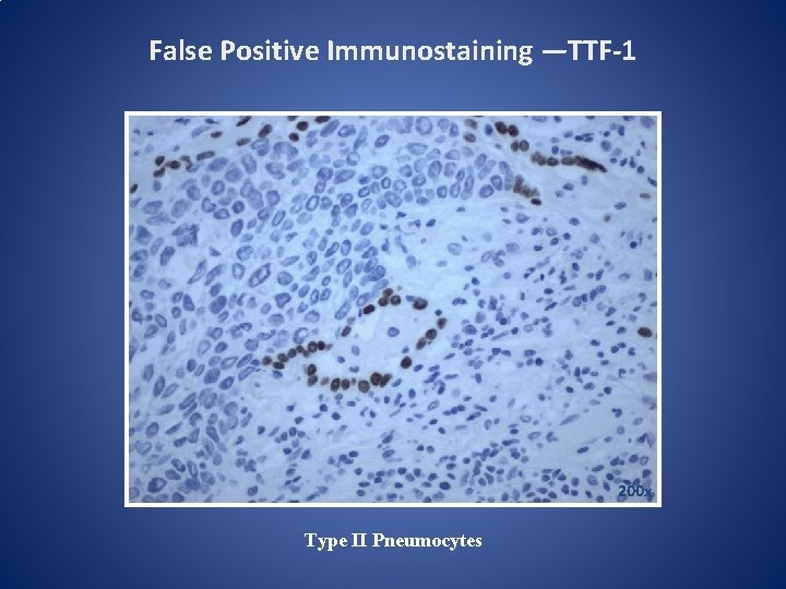 False Positive Immunostaining —TTF-1 200 x Type II Pneumocytes 