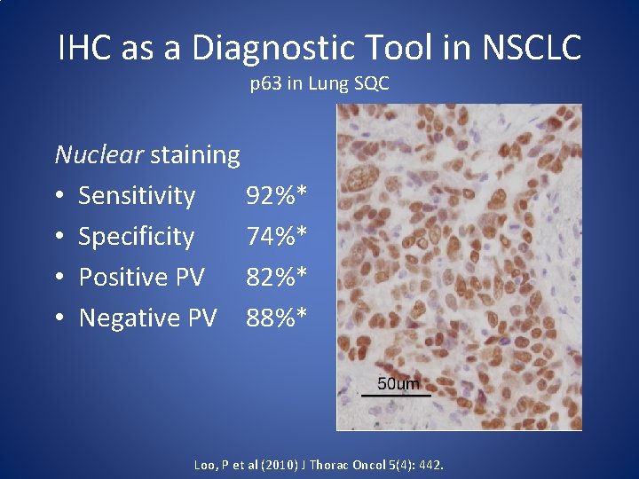 IHC as a Diagnostic Tool in NSCLC p 63 in Lung SQC Nuclear staining