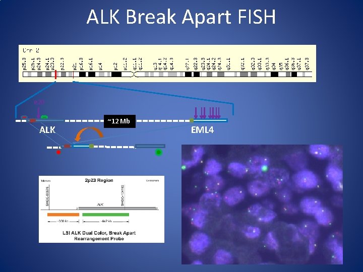 ALK Break Apart FISH e 20 ALK ~12 Mb EML 4 