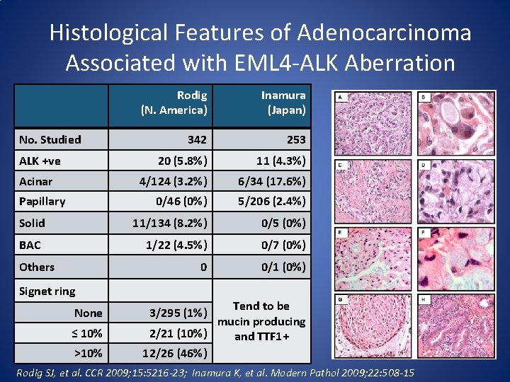 Histological Features of Adenocarcinoma Associated with EML 4 -ALK Aberration No. Studied ALK +ve
