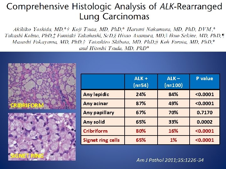 CRIBRIFORM SIGNET RING ALK + (n=54) ALK – (n=100) P value Any lepidic 24%