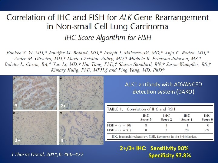 ALK 1 antibody with ADVANCED detection system (DAKO) 3+ 2+ 1+ 0 J Thorac