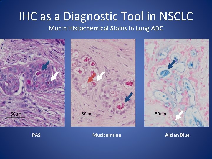 IHC as a Diagnostic Tool in NSCLC Mucin Histochemical Stains in Lung ADC PAS