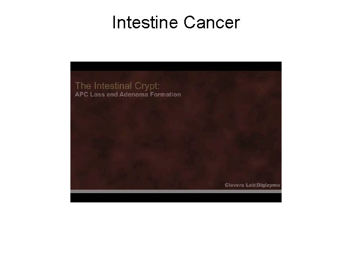 Intestine Cancer 