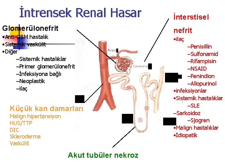 İntrensek Renal Hasar Glomerülonefrit • Anti-GBM hastalık • Sistemik vaskülit • Diğer –Sistemik hastalıklar