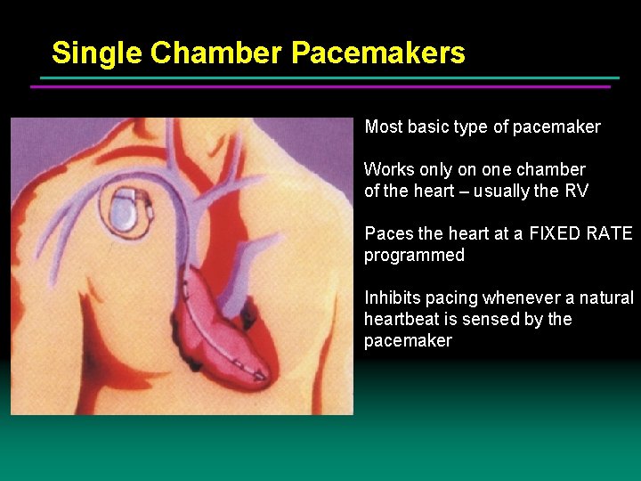 Single Chamber Pacemakers Most basic type of pacemaker Works only on one chamber of