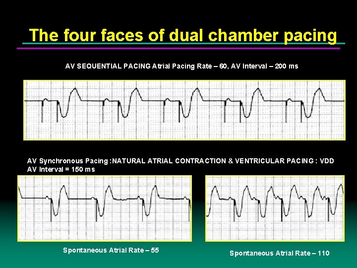 The four faces of dual chamber pacing AV SEQUENTIAL PACING Atrial Pacing Rate –