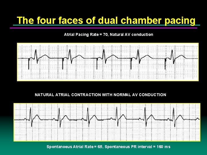 The four faces of dual chamber pacing Atrial Pacing Rate = 70, Natural AV
