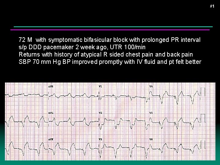 #1 72 M with symptomatic bifasicular block with prolonged PR interval s/p DDD pacemaker