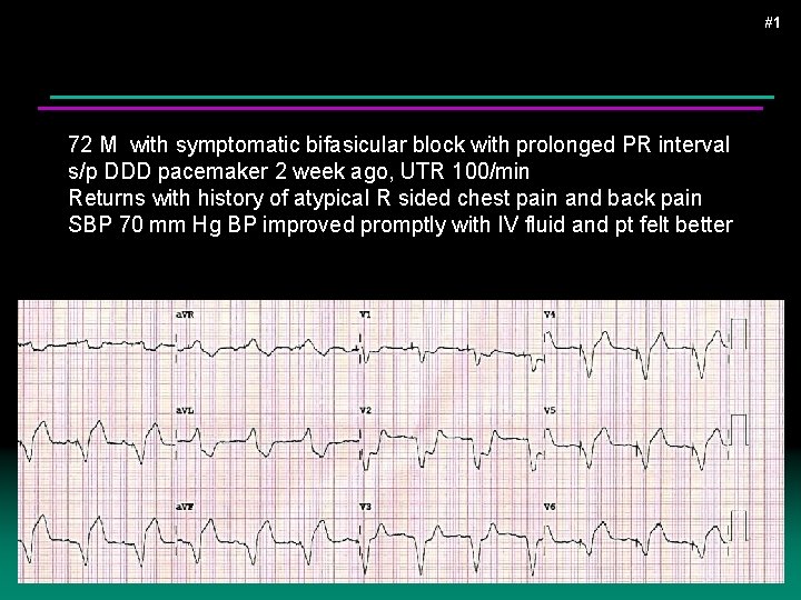 #1 72 M with symptomatic bifasicular block with prolonged PR interval s/p DDD pacemaker #1 72 M with symptomatic bifasicular block with prolonged PR interval s/p DDD pacemaker
