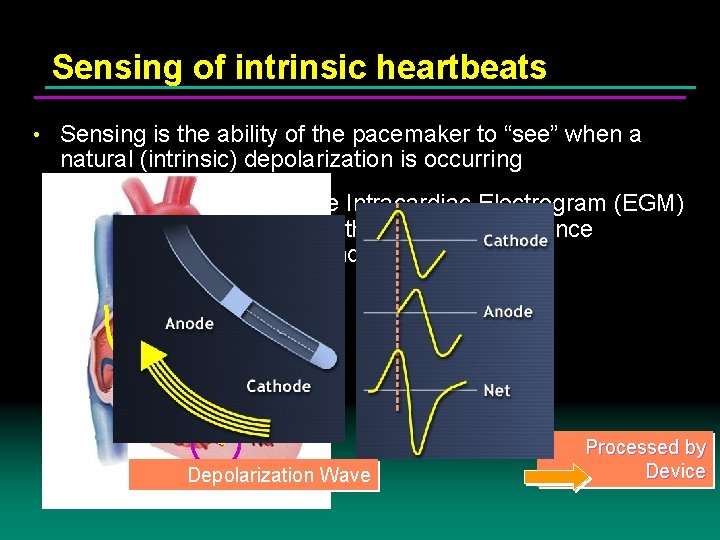 Sensing of intrinsic heartbeats • Sensing is the ability of the pacemaker to “see”