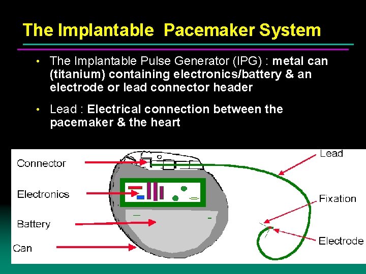 The Implantable Pacemaker System • The Implantable Pulse Generator (IPG) : metal can (titanium) The Implantable Pacemaker System • The Implantable Pulse Generator (IPG) : metal can (titanium)