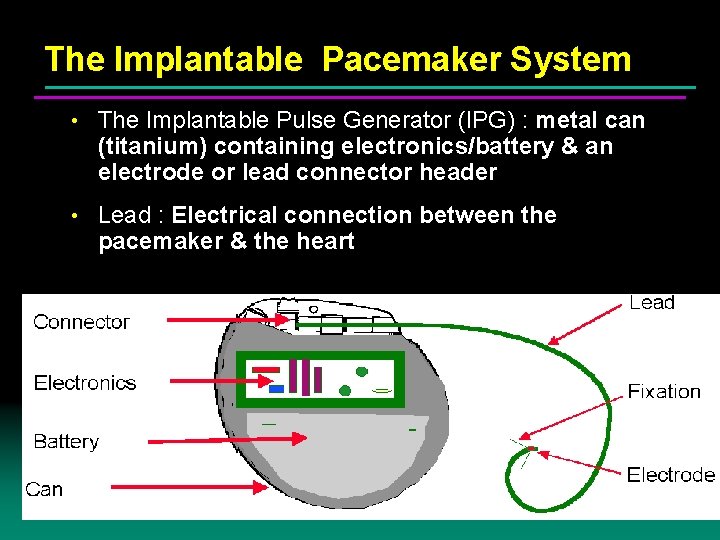 The Implantable Pacemaker System • The Implantable Pulse Generator (IPG) : metal can (titanium)