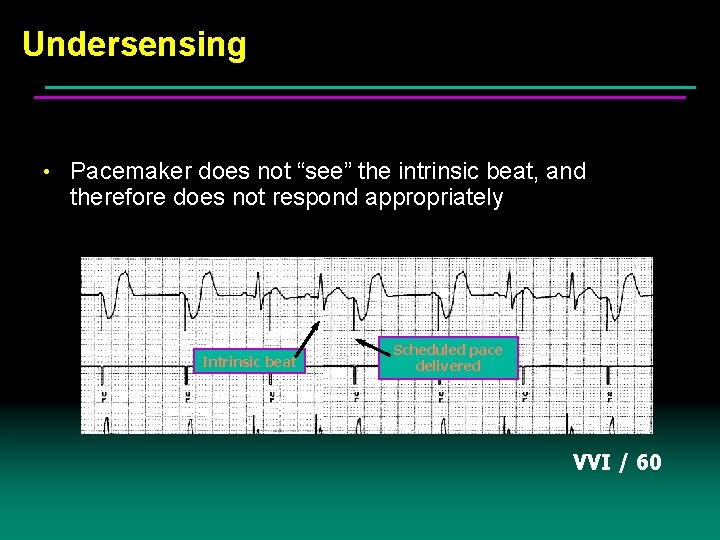 Undersensing • Pacemaker does not “see” the intrinsic beat, and therefore does not respond Undersensing • Pacemaker does not “see” the intrinsic beat, and therefore does not respond