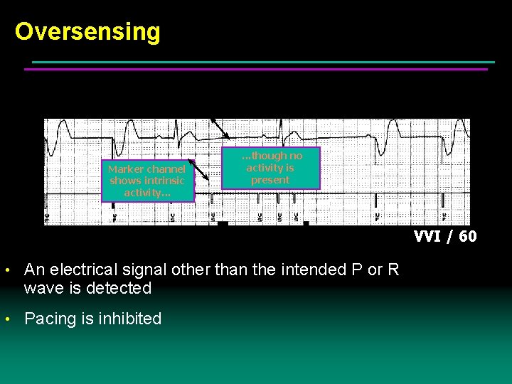 Oversensing Marker channel shows intrinsic activity. . . though no activity is present VVI