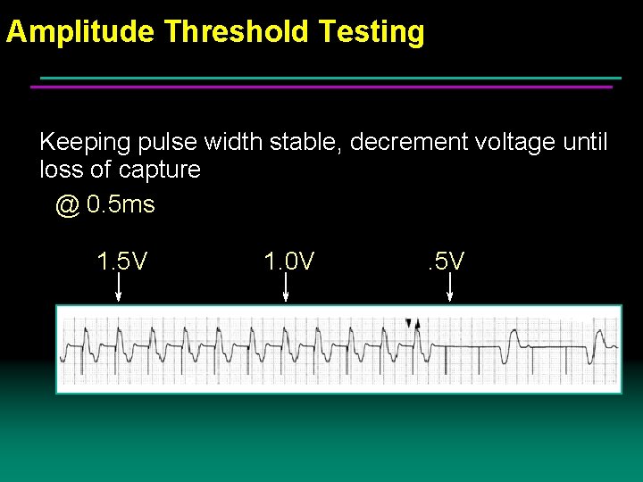 Amplitude Threshold Testing Keeping pulse width stable, decrement voltage until loss of capture @