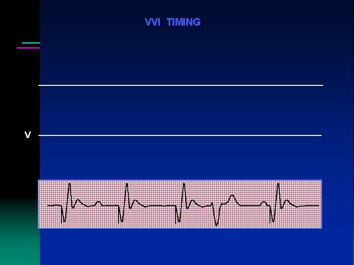 VVI TIMING V VP VP VP VS VP 